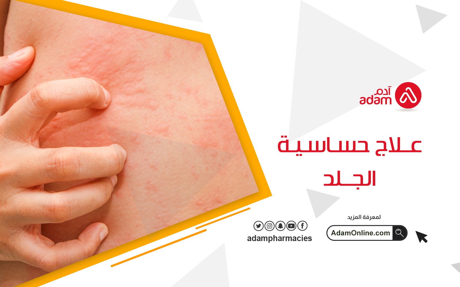 Treatment of skin allergies